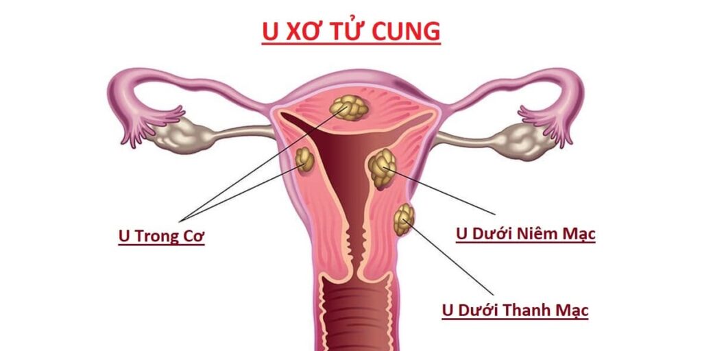 Cách Thực Hành Chữa U Xơ Tử Cung Bằng Diện Chẩn – Lương Y Hoàng Chu