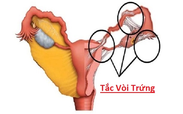 Cách Thực Hành Chữa Tắc Vòi Trứng Bằng Diện Chẩn – Hoàng Chu