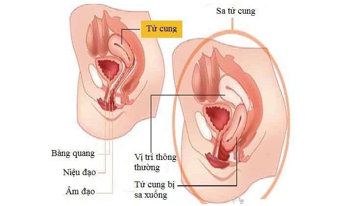 Cách Chữa Sa Tử Cung, Sa Ruột Bằng Diện Chẩn – Lương Y Hoàng Chu