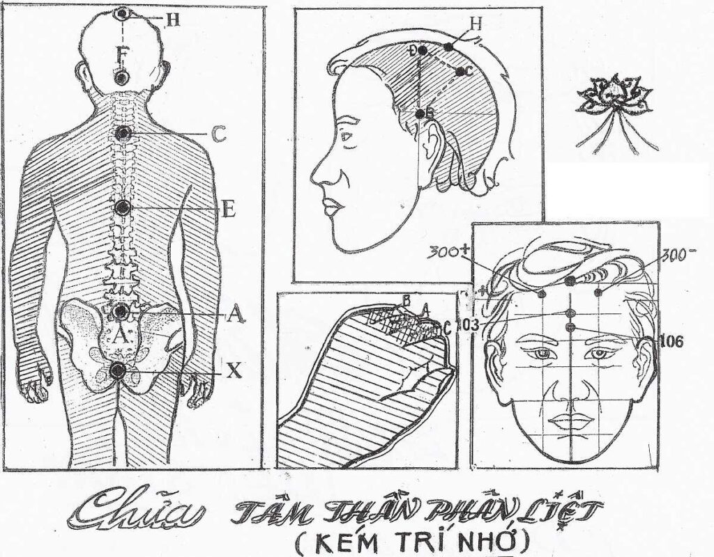 Phát Đồ Thực Hiện Chữa Thần Phân Liệt (Kém Trí Nhớ)  – Lương Y Hoàng Chu