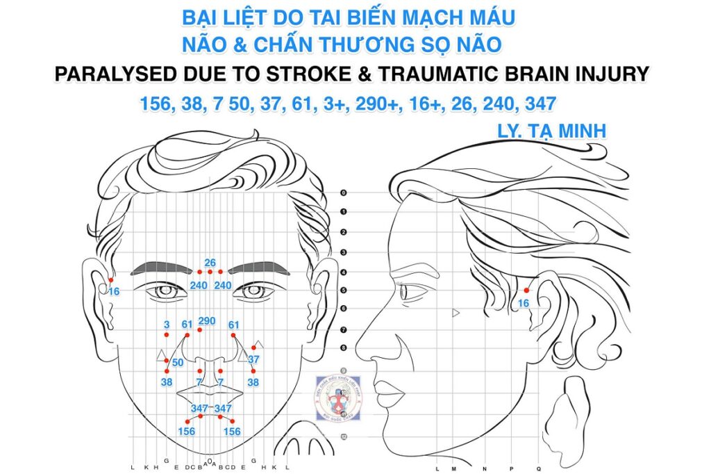 Cách Điều trị Bị Liệt Do Tai Biến Mạch Máu Não Và Chấn Thương Sọ Não Bằng Diên Chẩn - Lý Tạ Minh