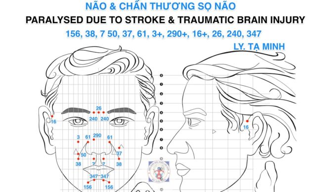 Cách Điều trị Bị Liệt Do Tai Biến Mạch Máu Não Và Chấn Thương Sọ Não Bằng Diên Chẩn - Lý Tạ Minh