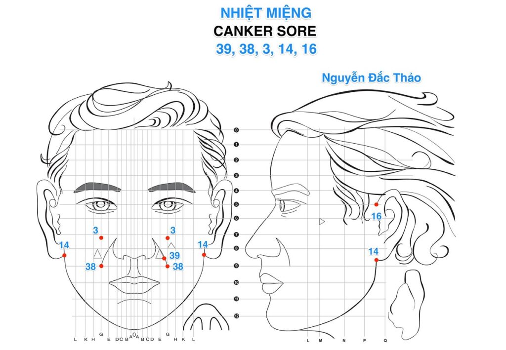 Phát Đồ và Cách Xử Lý Khi Bị Nhiệt Miệng (Canker Sore) Bằng Diện Chẩn