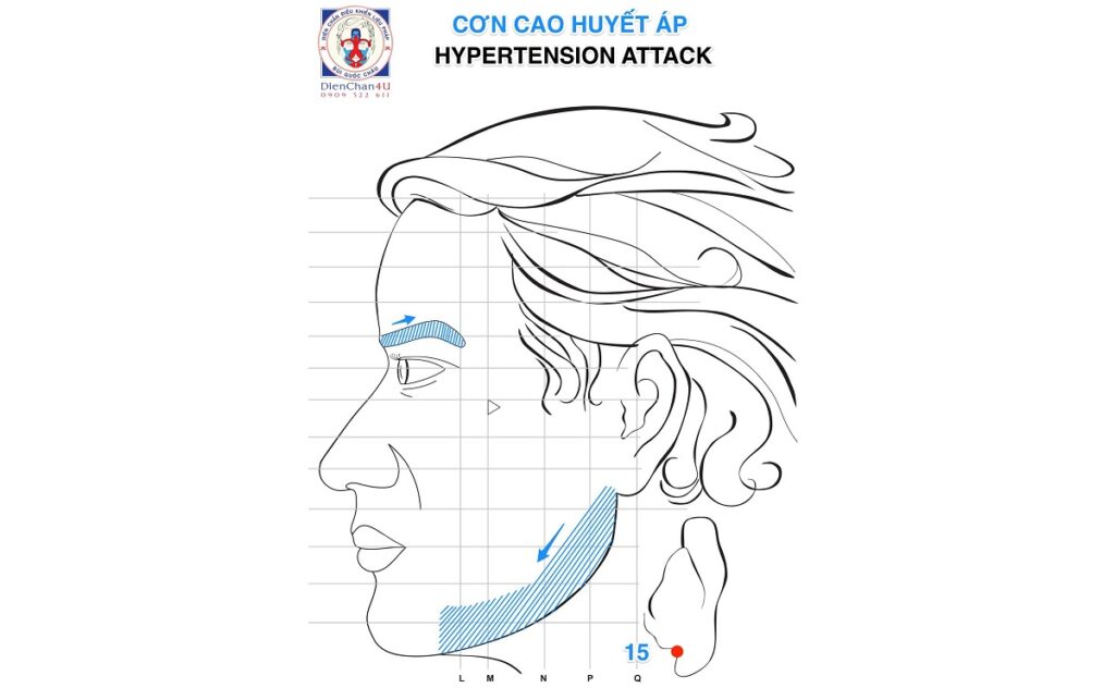 Cắt Cơn Cao Huyết Áp (Hypertension Attack) Bằng Diện Chẩn