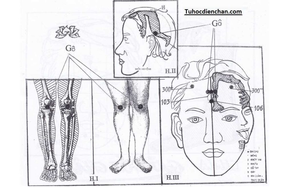 Cách Chữa Gai Khớp Gối Bằng Diện Chẩn - Phác Đồ Hoàng Chu