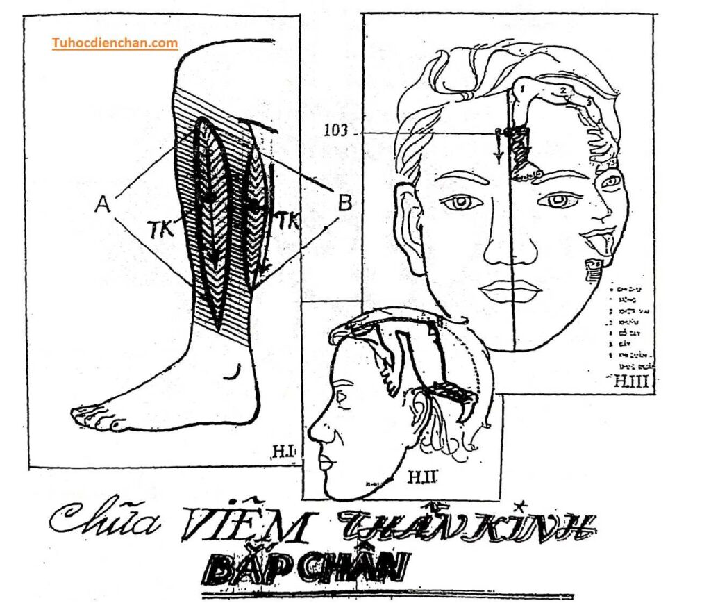 Cách Thực Hiện Phác Đồ Chữa Viêm Thần Kinh Bắp Chân của Lương Y Hoàng Chu