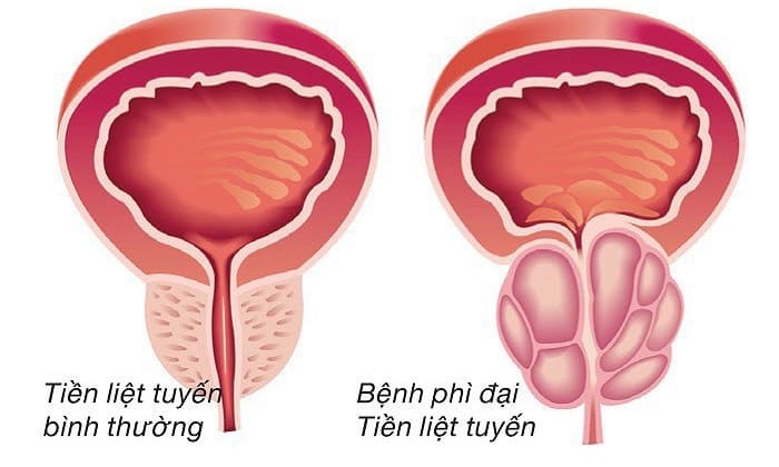 Bệnh Phì đại tiền liệt tuyến là gì?