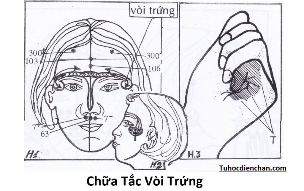 Phát Đồ Thực Hiện Chữa Tắc Vòi Trứng – Lương Y Hoàng Chu