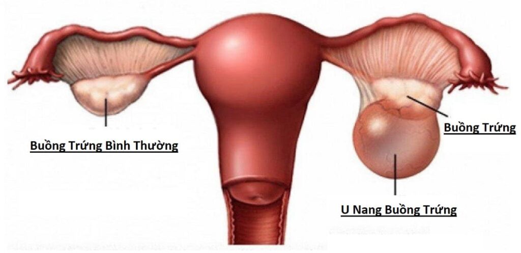 Cách Thực Hành Chữa U Nang Buồng Trứng Bằng Diện Chẩn – Lương Y Hoàng Chu