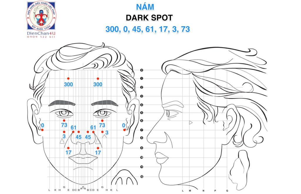 Phác Đồ Huyệt Và Cách Trị Nám (Dark Spot) Bằng Diện Chẩn Bùi Quốc Châu