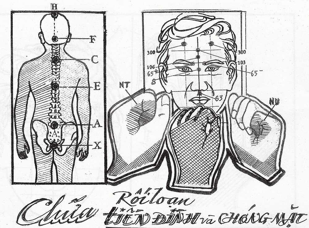 Chữa Rối Loạn Tiền Đình, Chóng Mặt Bằng Diện Chẩn