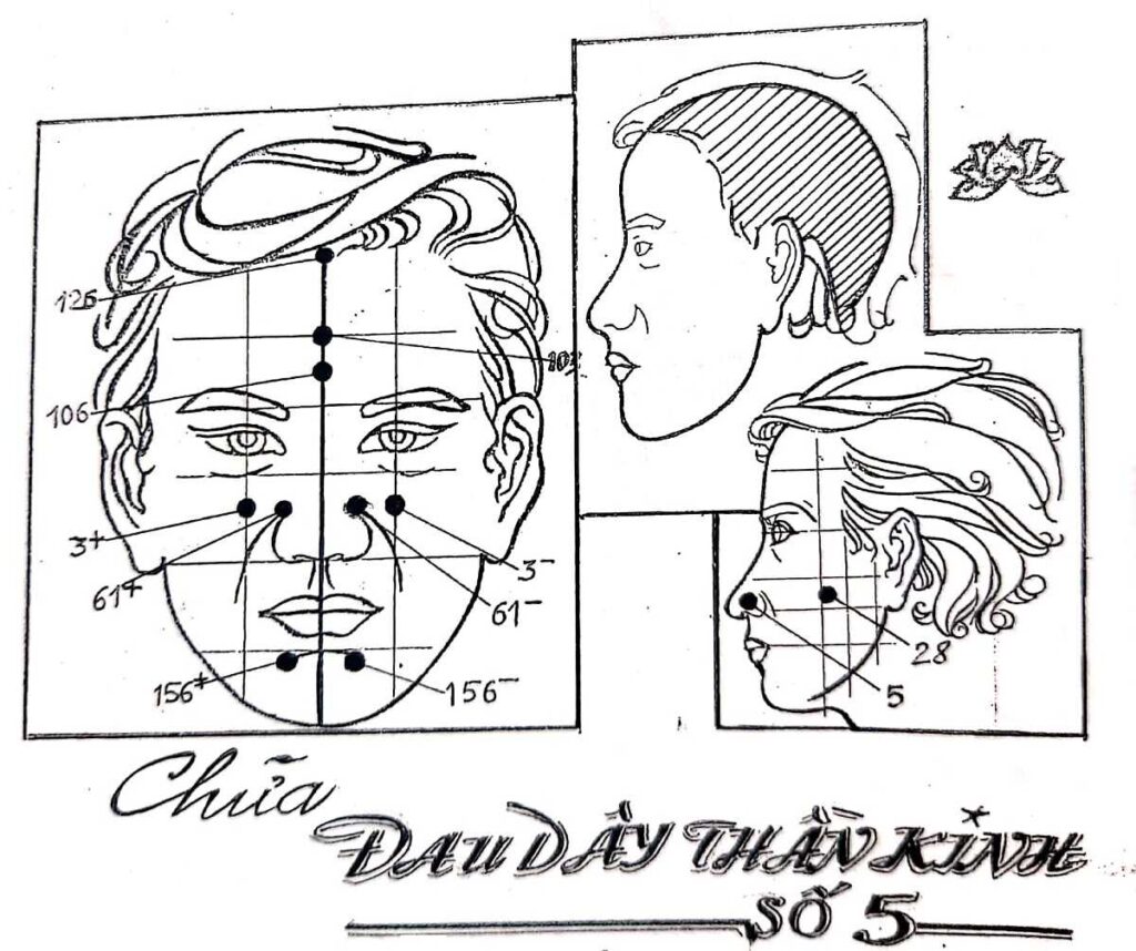 Cách Chữa Đau Dây Thần Kinh Số 5 Bằng Diện Chẩn – Lương Y Hoàng Chu